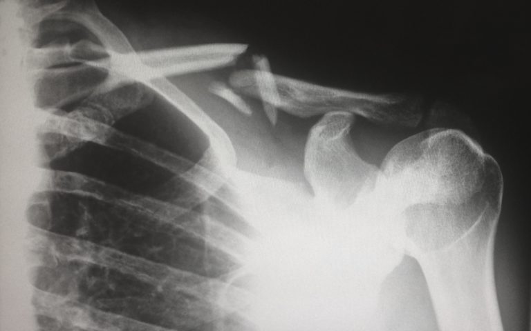 Should I Settle My Personal Injury Claim If I Haven’t Finished Treatment?